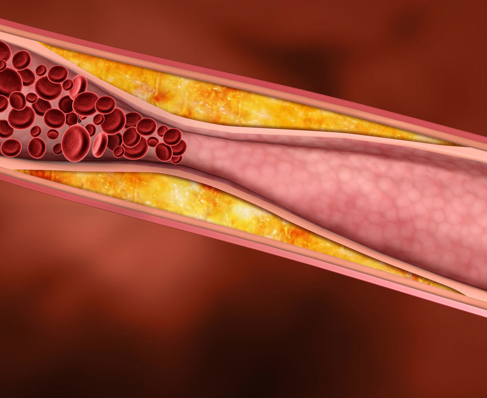 - DETEKSI DINI DISLIPIDEMIA
