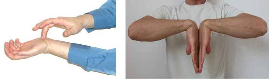 - Carpal Tunnel Syndrome (Sindroma Terowongan Karpal)