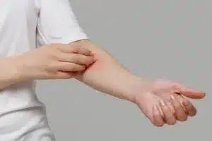 Keracunan Histamin